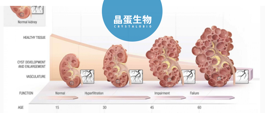 不容忽视的遗传性疾病——多囊肾病